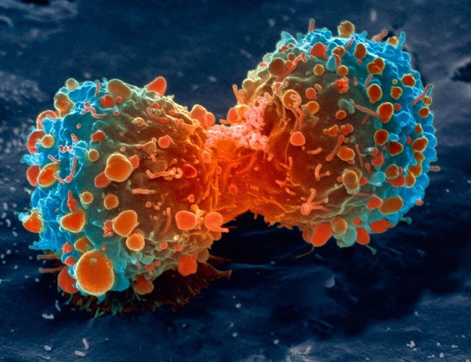 туморни клетки като усложнение на простатит