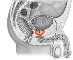 Восспаление на простатата